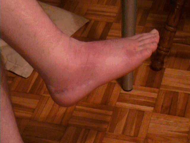 A rather bruised, swollen foot